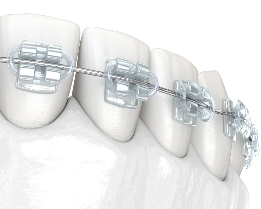 Tooth-colored ceramic braces that appear translucent on teeth.